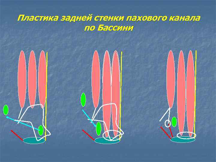 Пластика пахового канала по бассини