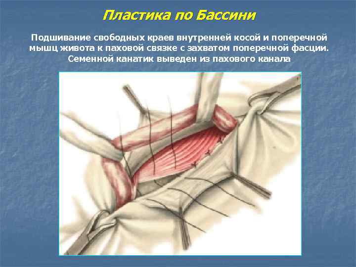 Пластика по Бассини Подшивание свободных краев внутренней косой и поперечной мышц живота к паховой