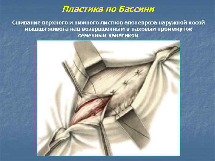 Пластика по Бассини Сшивание верхнего и нижнего листков апоневроза наружной косой мышцы живота над