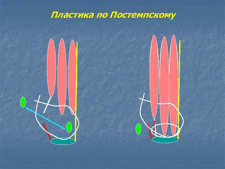 Пластика по Постемпскому 