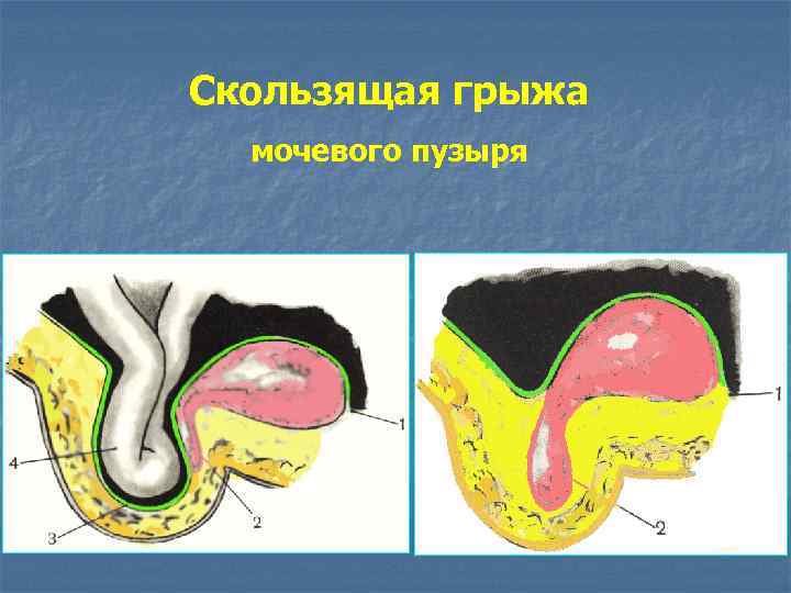 Скользящая грыжа