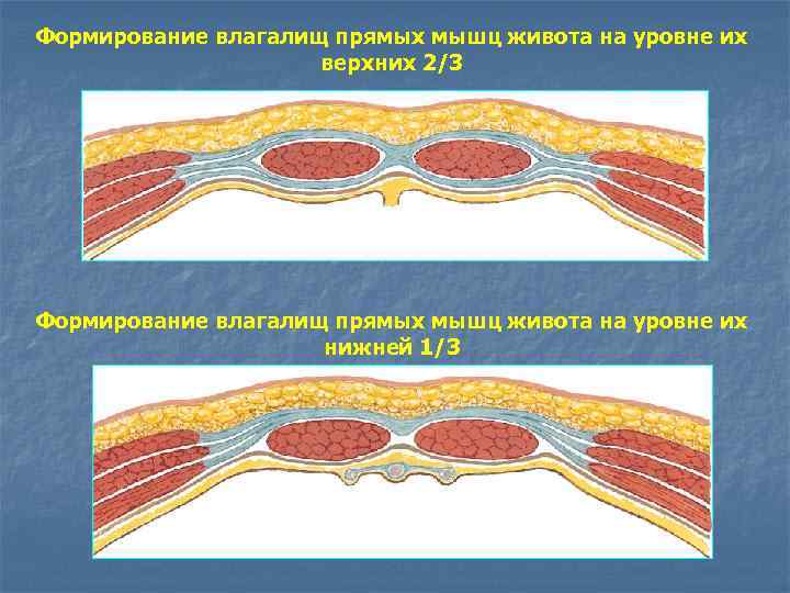 Поперечный распил передней брюшной стенки выше и ниже пупка схема
