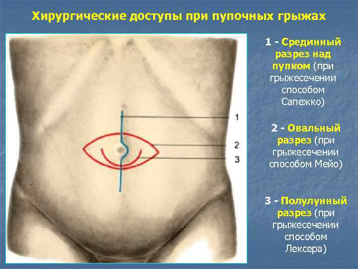 Хирургические доступы при пупочных грыжах 1 - Срединный разрез над пупком (при грыжесечении способом