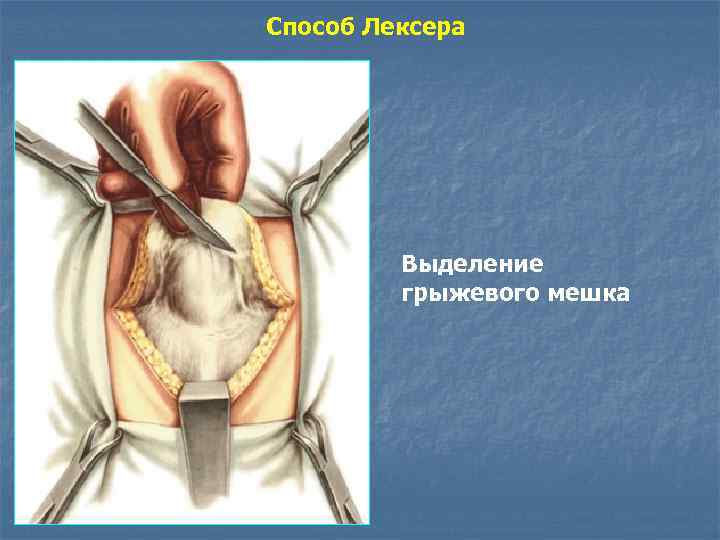 Способ Лексера Выделение грыжевого мешка 