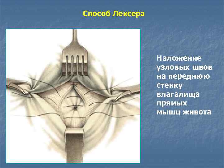 Способ Лексера Наложение узловых швов на переднюю стенку влагалища прямых мышц живота 