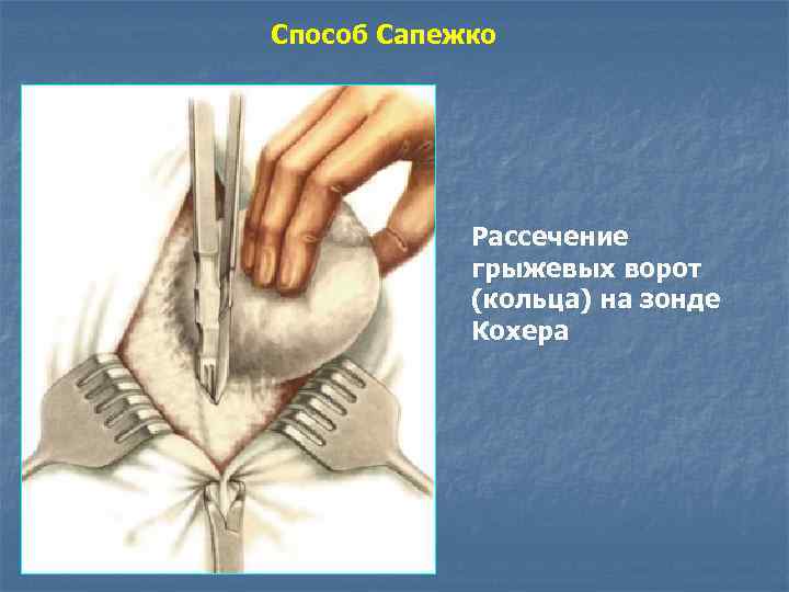 Способ Сапежко Рассечение грыжевых ворот (кольца) на зонде Кохера 