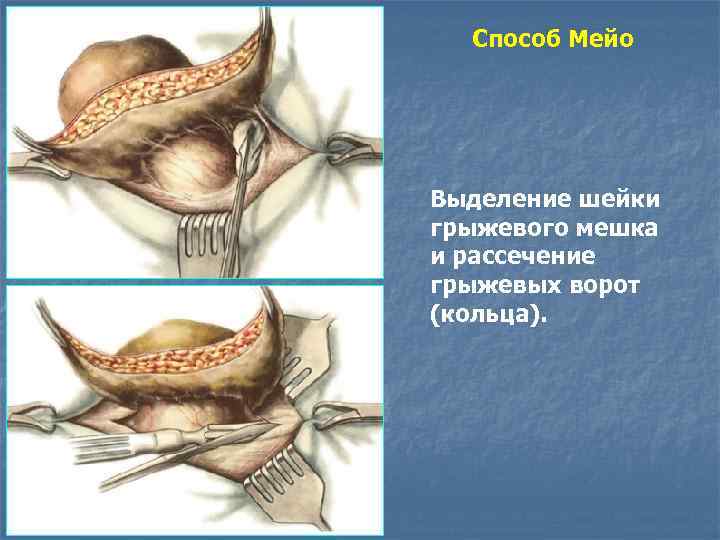 Способ Мейо Выделение шейки грыжевого мешка и рассечение грыжевых ворот (кольца). 