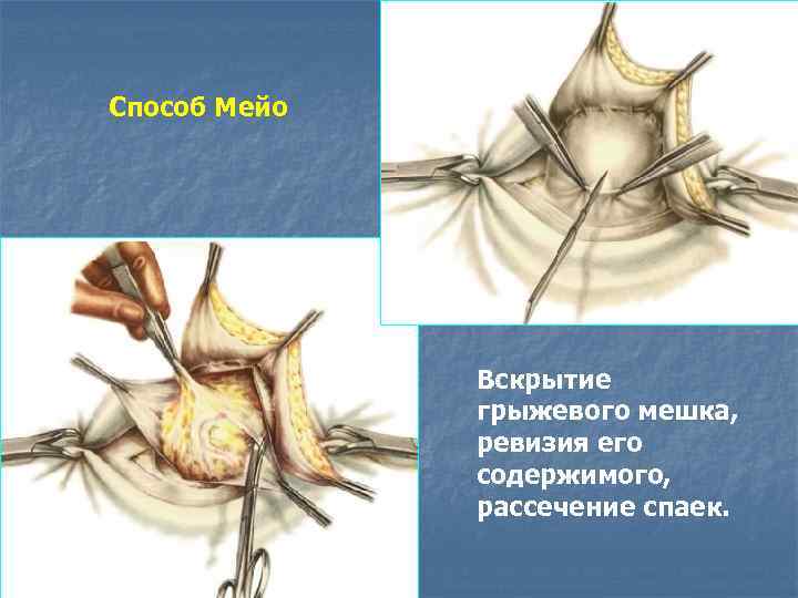 Пластика по мейо картинки