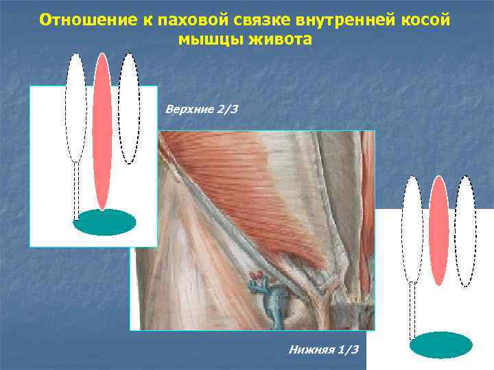 Отношение к паховой связке внутренней косой мышцы живота Верхние 2/3 Нижняя 1/3 