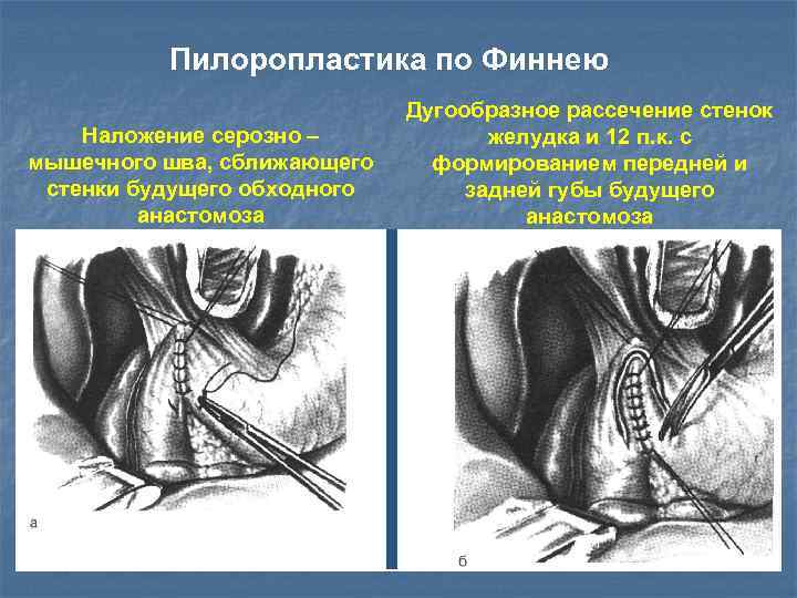 Пилоропластика по финнею схема