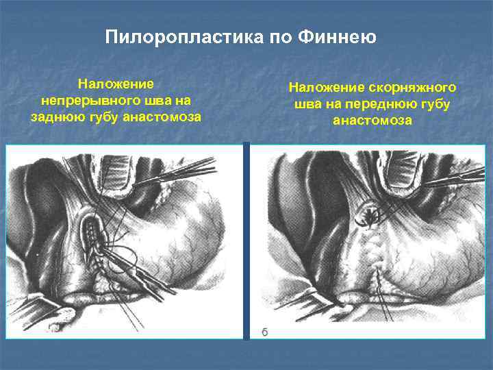 Пилоропластика по Финнею Наложение непрерывного шва на заднюю губу анастомоза Наложение скорняжного шва на