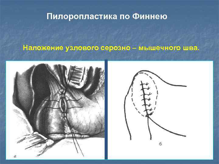 Пилоропластика по финнею схема