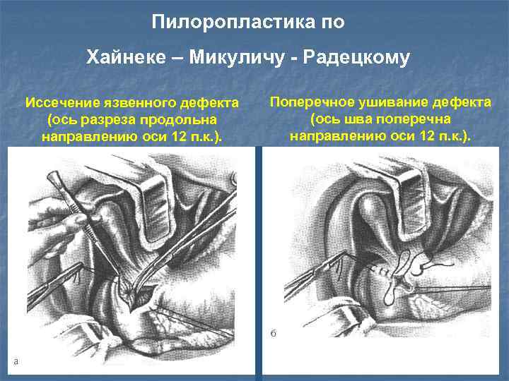 Пилоропластика по Хайнеке – Микуличу - Радецкому Иссечение язвенного дефекта (ось разреза продольна направлению