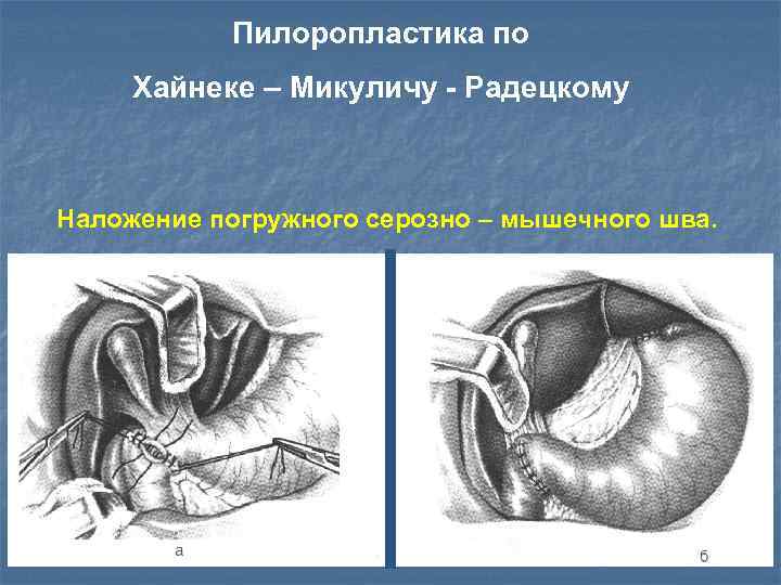 Пилоропластика по финнею схема