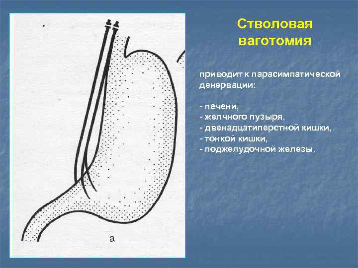 Стволовая ваготомия приводит к парасимпатической денервации: - печени, - желчного пузыря, - двенадцатиперстной кишки,