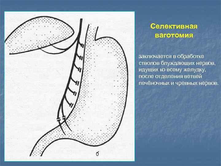 Селективная ваготомия заключается в обработке стволов блуждающих нервов, идущих ко всему желудку, после отделения