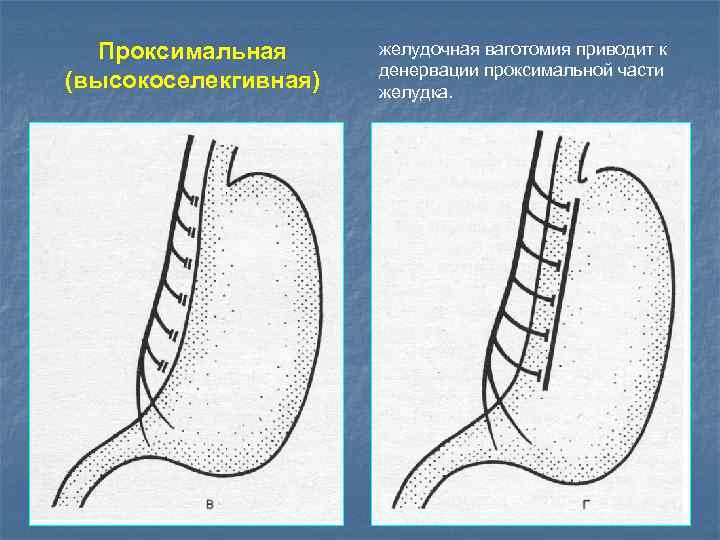 Проксимальная (высокоселекгивная) желудочная ваготомия приводит к денервации проксимальной части желудка. 