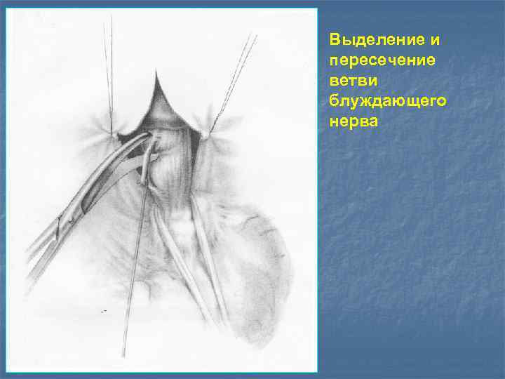 Выделение и пересечение ветви блуждающего нерва 