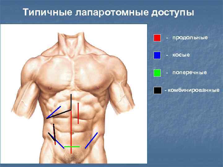 Типичные лапаротомные доступы - продольные - косые - поперечные - комбинированные 