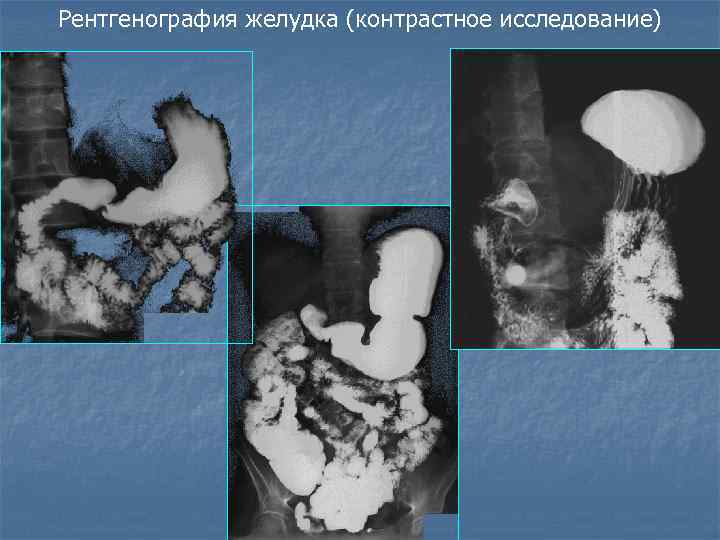 Рентгенография желудка (контрастное исследование) 