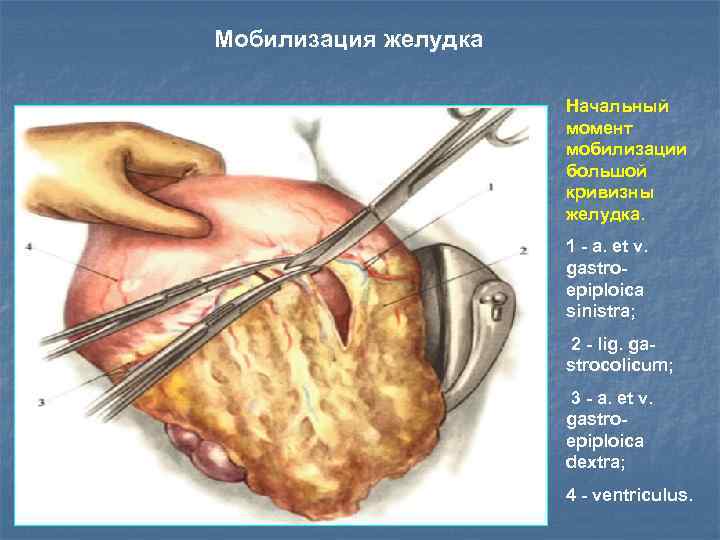 Мобилизация желудка Начальный момент мобилизации большой кривизны желудка. 1 - a. et v. gastroepiploica