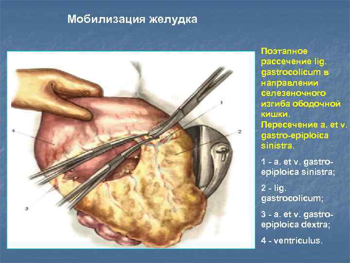 Мобилизация желудка Поэтапное рассечение lig. gastrocolicum в направлении селезеночного изгиба ободочной кишки. Пересечение a.