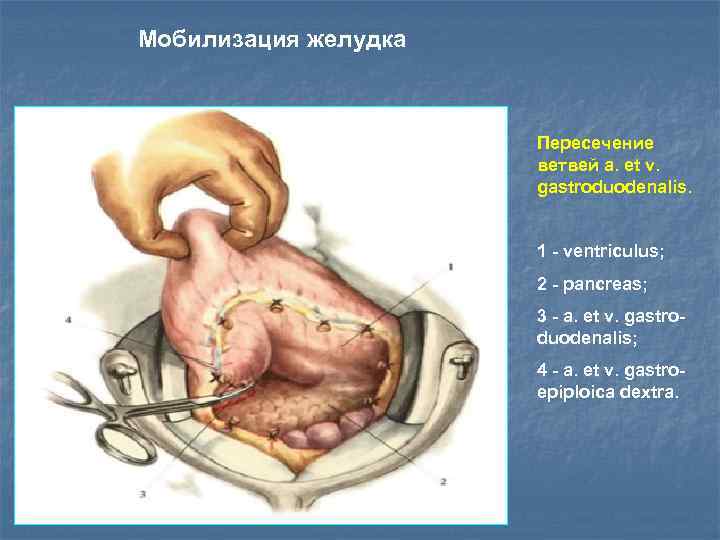 Мобилизация желудка Пересечение ветвей a. et v. gastroduodenalis. 1 - ventriculus; 2 - pancreas;