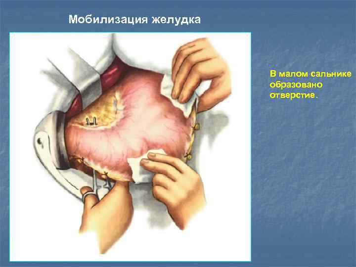 Малый сальник образован. Большой и малый сальник желудка.