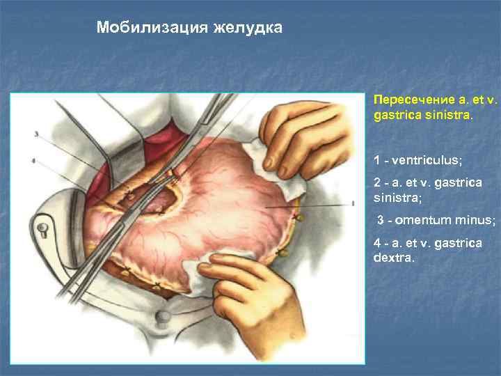 Мобилизация желудка Пересечение а. et v. gastrica sinistra. 1 - ventriсulus; 2 - a.