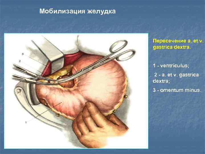 Мобилизация желудка Пересечение a. et v. gastrica dextra. 1 - ventriculus; 2 - a.