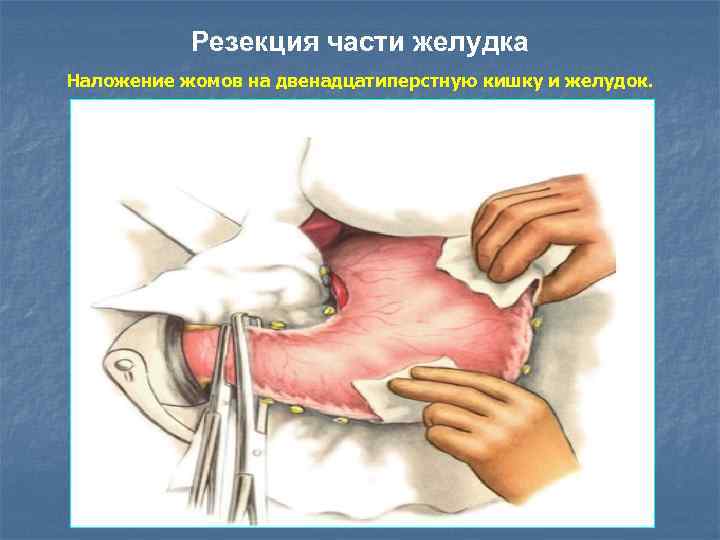 Резекция части желудка Наложение жомов на двенадцатиперстную кишку и желудок. 