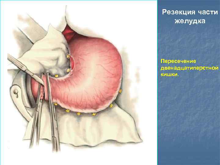 Резекция части желудка Пересечение двенадцатиперстной кишки. 