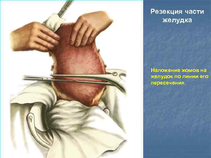 Резекция части желудка Наложение жомов на желудок по линии его пересечения. 