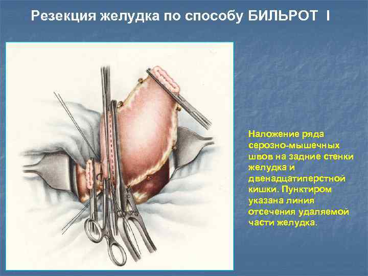 Резекция желудка по способу БИЛЬРОТ I Наложение ряда серозно-мышечных швов на задние стенки желудка