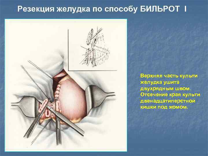 Резекция желудка по способу БИЛЬРОТ I Верхняя часть культи желудка ушита двухрядным швом. Отсечение