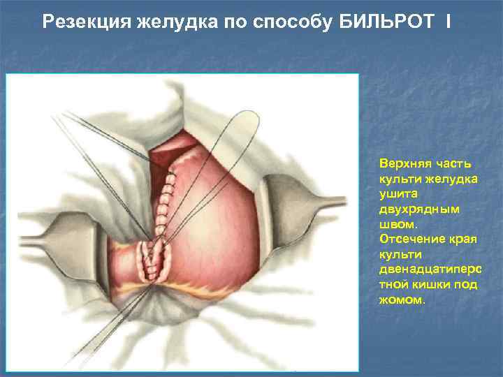 Резекция желудка по способу БИЛЬРОТ I Верхняя часть культи желудка ушита двухрядным швом. Отсечение