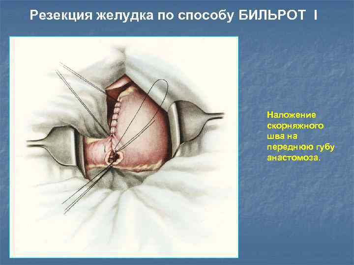 Резекция желудка по способу БИЛЬРОТ I Наложение скорняжного шва на переднюю губу анастомоза. 