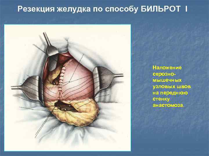 Резекция желудка по способу БИЛЬРОТ I Наложение серозномышечных узловых швов на переднюю стенку анастомоза.