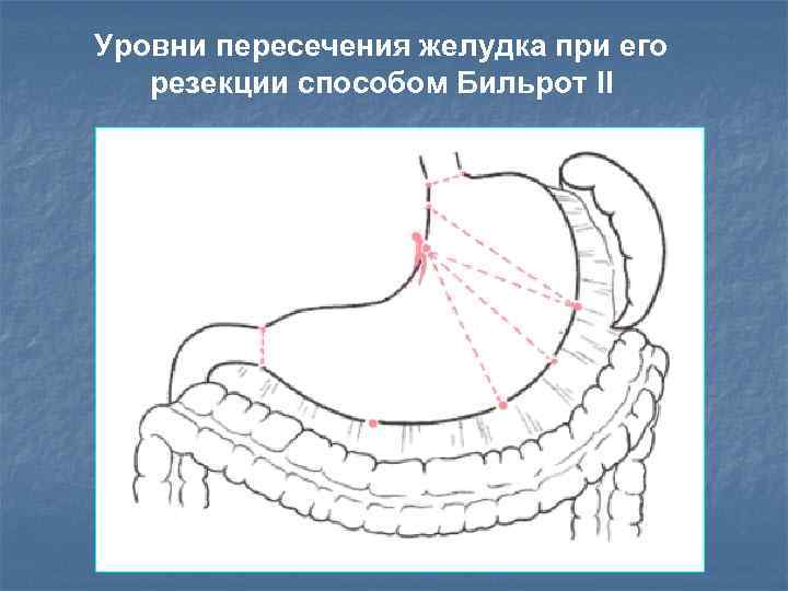 Уровни пересечения желудка при его резекции способом Бильрот II 