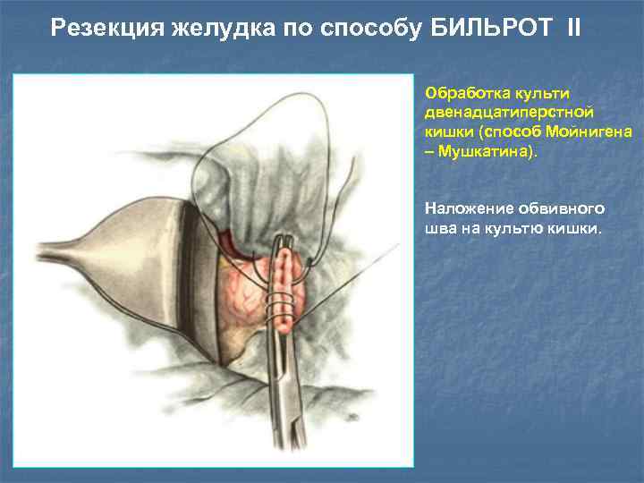 Резекция желудка по способу БИЛЬРОТ II Обработка культи двенадцатиперстной кишки (cпособ Мойнигена – Мушкатина).