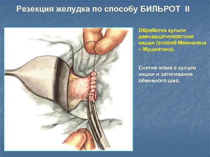 Резекция желудка по способу БИЛЬРОТ II Обработка культи двенадцатиперстной кишки (cпособ Мойнигена – Мушкатина).