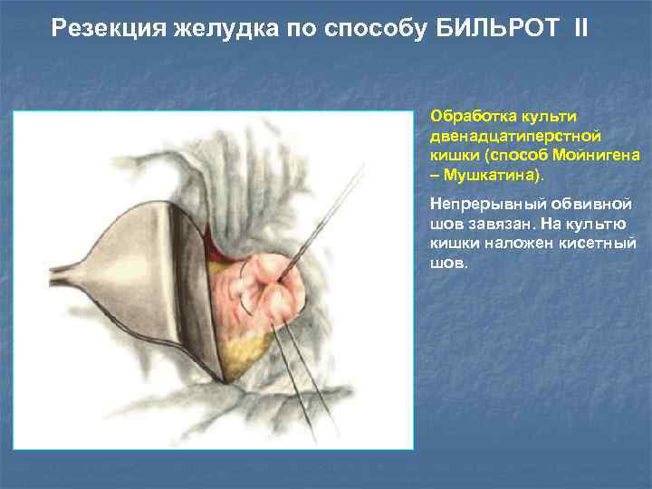 Резекция желудка по способу БИЛЬРОТ II Обработка культи двенадцатиперстной кишки (cпособ Мойнигена – Мушкатина).