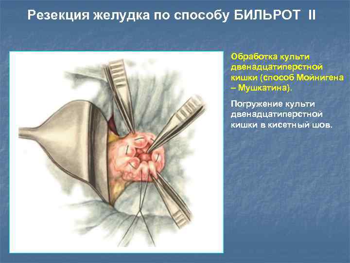 Резекция желудка по способу БИЛЬРОТ II Обработка культи двенадцатиперстной кишки (cпособ Мойнигена – Мушкатина).