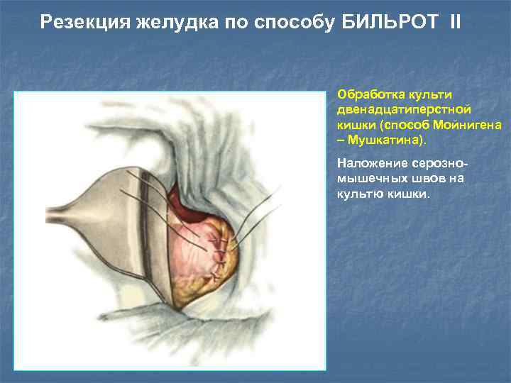 Резекция желудка по способу БИЛЬРОТ II Обработка культи двенадцатиперстной кишки (cпособ Мойнигена – Мушкатина).