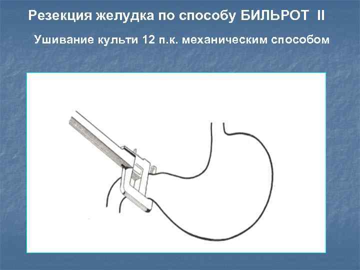 Резекция желудка по способу БИЛЬРОТ II Ушивание культи 12 п. к. механическим способом 