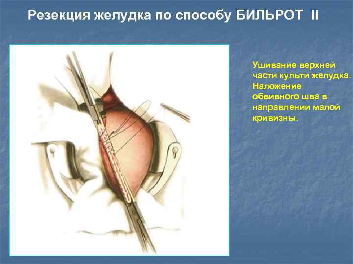 Резекция желудка по способу БИЛЬРОТ II Ушивание верхней части культи желудка. Наложение обвивного шва