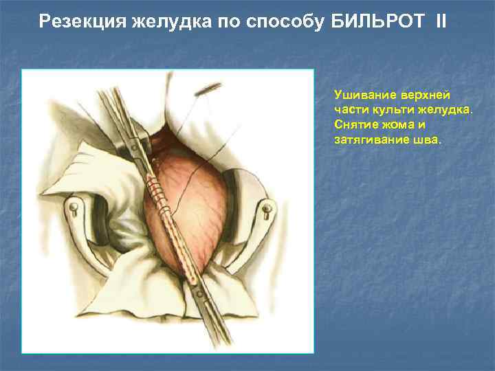 Резекция желудка по способу БИЛЬРОТ II Ушивание верхней части культи желудка. Снятие жома и