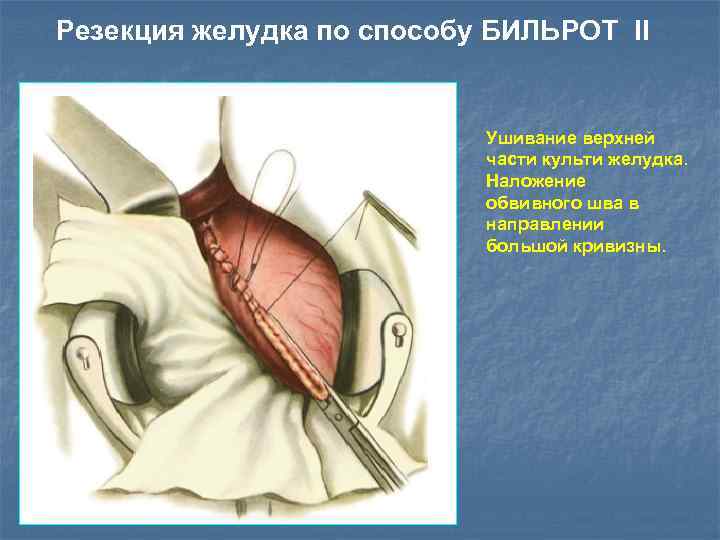 Резекция желудка по способу БИЛЬРОТ II Ушивание верхней части культи желудка. Наложение обвивного шва