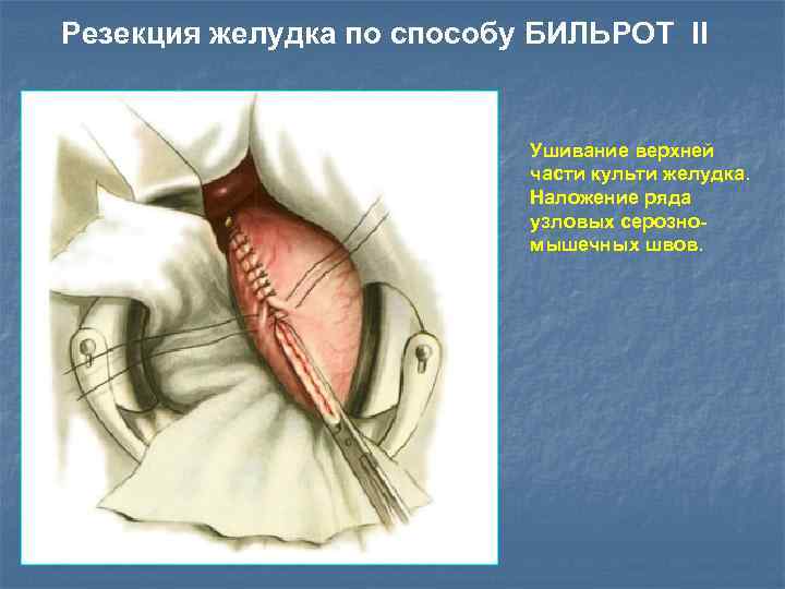 Резекция желудка по способу БИЛЬРОТ II Ушивание верхней части культи желудка. Наложение ряда узловых