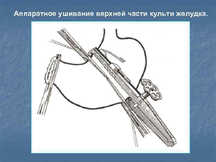 Аппаратное ушивание верхней части культи желудка. 